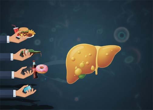 ফ্যাটি লিভার ক্যান্সারের পথে ঠেলে দেয়